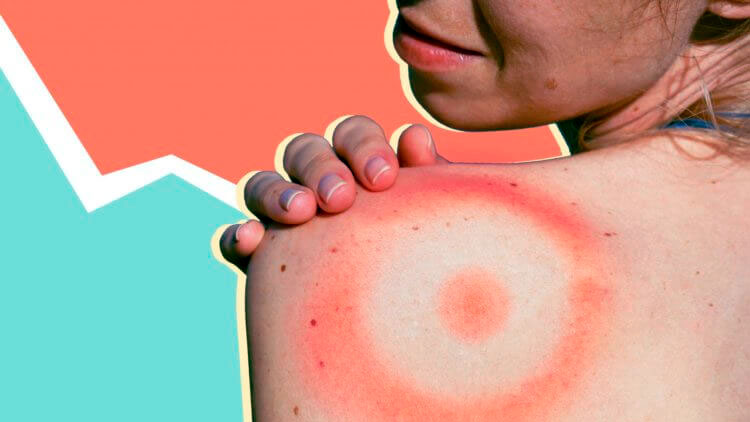 Известный антибиотик может вылечить болезнь, возникающую при укусе клещей