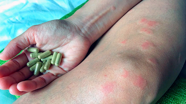 Создано лекарство от волчанки