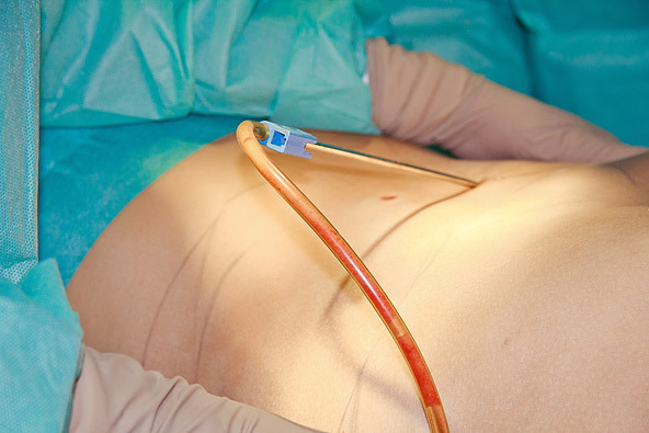 Липосакция: виды и показания