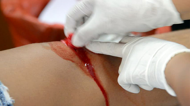Новый хирургический клей затягивает рану за 60 секунд