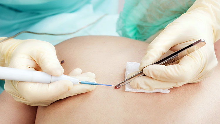 Ученые: найдено лекарство от рака кожи