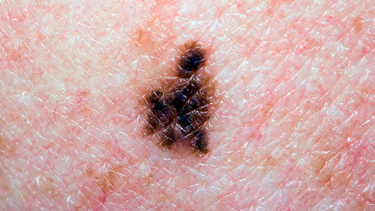 Новый анализ крови определяет меланому на ранней стадии