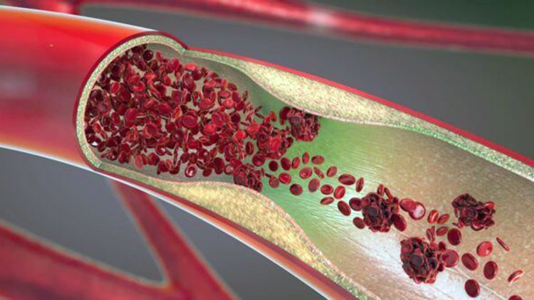 гидрогель, способный остановить артериальное кровотечение