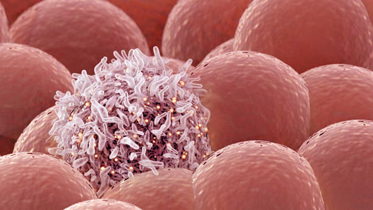 достижения в лечении меланомы